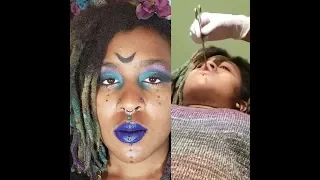 Getting my medusa/philtrum pierced (Day 1) - Pain/Swelling/Aftercare