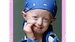 A tribute to Hayley Okines!! - RIP Hayley (Supporting Progeria UK)