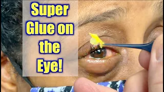 Super glue in the eye! How does this happen???