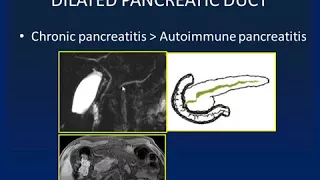 imaging Dilated Pancreatic Duct - HD [Basic Radiology]