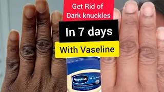 How to LIGHTEN Dark Knuckles Fast With VASELINE In (7 Days)