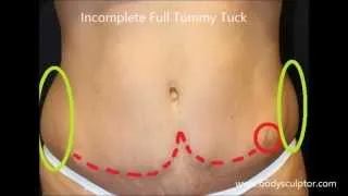 Botched:Tummy Tuck  Plastic Surgery Gone Wrong fixed by Dr. Placik [Tummy Tuck]