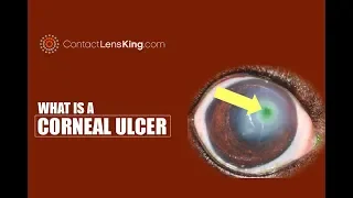 Corneal Ulcer Causes, Symptoms, Treatments