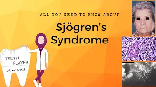 Sjogren’s Syndrome | PRIMARY & SECONDARY | SYMPTOMS, DIAGNOSIS & TREATMENT | ORAL PATHOLOGY NOTES |