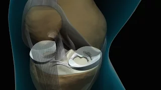 Torn Knee Meniscus Repair