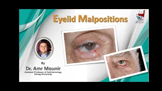 Eyelid Malpositions