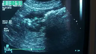 sigmoid colon cancer ultrasound