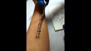 Removing surgical staples