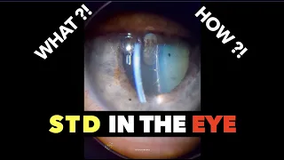 STD in the Eye | Syphilis | Uveitis