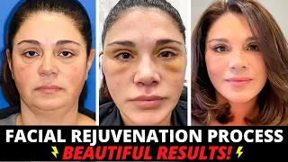 Incredible 50 Year Old Total Facial Rejuvenation: Facelift, eye lift, lip lift, fat transfer