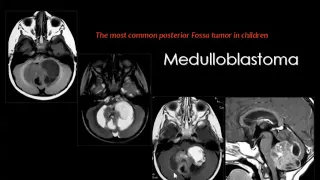 Imaging of Pediatric brain tumors Sep 2013   Dr Mamdouh Mahfouz In Arabic