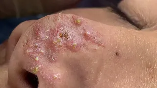 Suri Job #665: Great Extraction So Many Blackheads