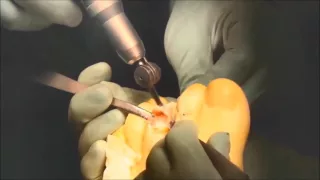 Hammertoe technique using Bioretec ActivaPin™ bioabsorbable pin
