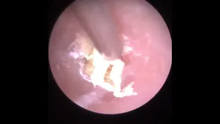 914 - Dead Skin Extracted from Stenotic Ear Canal