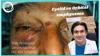 Eyelid vs Orbital Emphysema