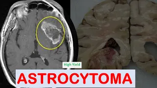 Brain Tumors: Part-1|| Astrocytoma ||