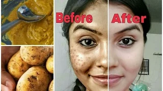 Remove dark spots in just 7 days | 100% Natural | Get rid of uneven skintone