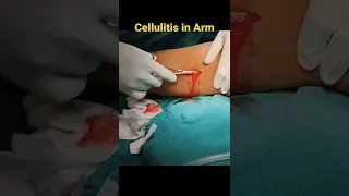 Cellulitis Emergency Treatment|| Incision & Drainage ||