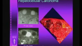 MR Imaging of Focal Liver Lesions   A Case Based Approach