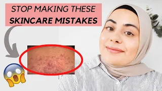 5 SKINCARE MISTAKES THAT COULD BE MAKING YOUR ACNE WORSE | Acne Skincare Mistakes | Razia Moe