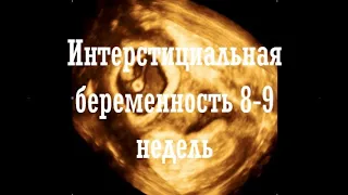 Интерстициальная беременность 8-9 недель