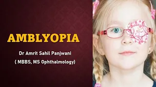 AMBLYOPIA ( lazy eye) EXPLAINED