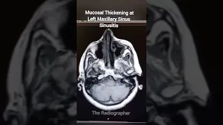 Mucosal Thickening at Left Maxillary Sinus Sinusitis | #sinusitis #mri #ct