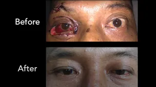 Early Management of Orbital Floor Fracture and Complex Eyelid Laceration