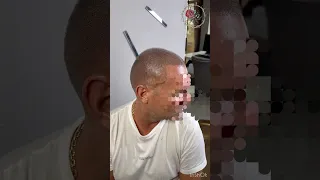 Позволь себе лучшее! Трихопигментация после пересадки волос. Scalp micropigmentation