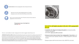 MI with plaque disruption on IVUS/OCT but stenosis less than 50%: should you stent?