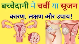 बच्चेदानी में सूजन या चर्बी के कारण लक्षण और उपाय/ bachedani me sujan ya charbi kaise hota hai