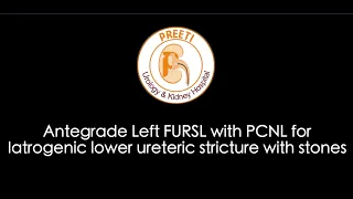 Antegrade Left FURSL with PCNL for Iatrogenic lower ureteric stricture with stones