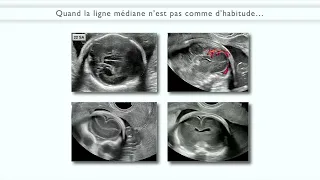 La ligne médiane il n’y a pas que le corps calleux