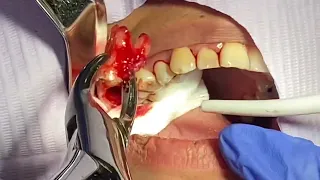 How To Remove Broken To Gum-Line Upper Molar