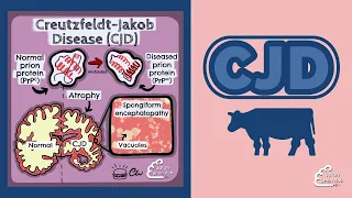 Creutzfeldt -Jakob Disease (CJD)