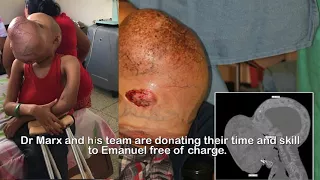 Boy has 10 pound tumor taking over his face