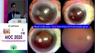 AIOC2020 GP145 T1 Dr Lalit Verma Practical Approach to Endophthalmitis