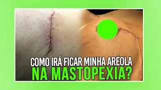 MASTOPEXIA COMO IRA FICAR MINHA ARÉOLA?  CIRURGIA PLÁSTICA