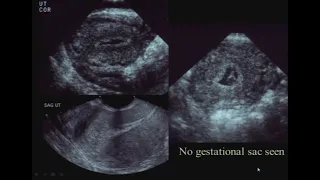 sonography of Ectopic Pregnancy