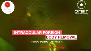 Removal of an Intraocular Foreign Body