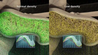 Echolight: REMS Technology Femur