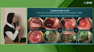 2. Николайчук Т.В., Агейкина Н.В. Гиперпластический полип больших размеров. Клинический случай.