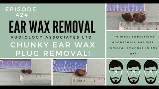 CHUNKY EAR WAX PLUG REMOVAL - EP424