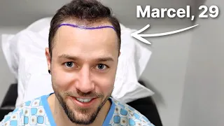 Marcel (29) bekommt volle Haare | Haartransplantation Erfahrung