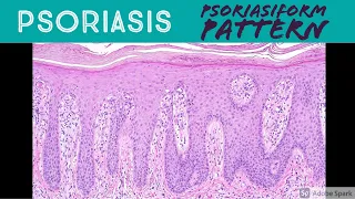 Psoriasis & Psoriasiform Dermatitis Pattern - Inflammatory Dermpath Basics for Dermatology Pathology