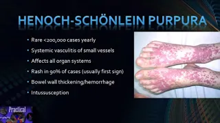 Henoch-Schönlein Purpura