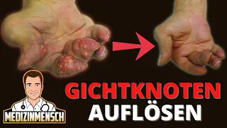 GICHTKNOTEN auflösen! (GICHT-ARZT erklärt wie es geht — ohne Chirurgie!)