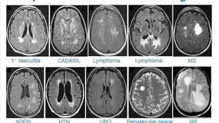 MRI Uses in MS