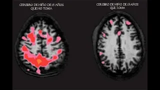 ¿Es menor de edad y toma? Así es cómo el alcohol atrofia el cerebro de un adolescente