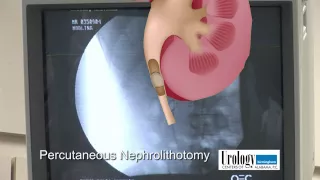 Percutaneous Nephrolithotomy Urology Centers of Alabama